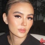 Alopecia Areata: Mengapa Agnez Mo Takutkan Kerontokan?